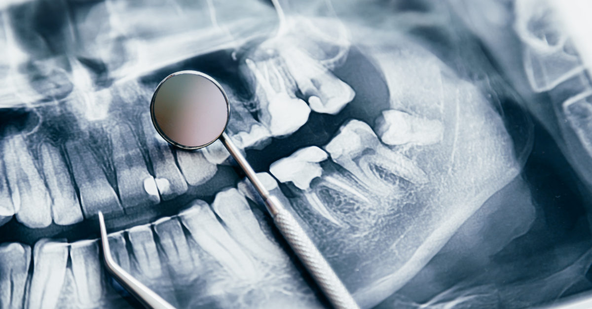 Çene Kırıkları ve Travmatik Yaralanmaların Tedavisi Çene Kırıkları ve Travmatik Yaralanmaların Tedavisi - Dt Ayşe Erken