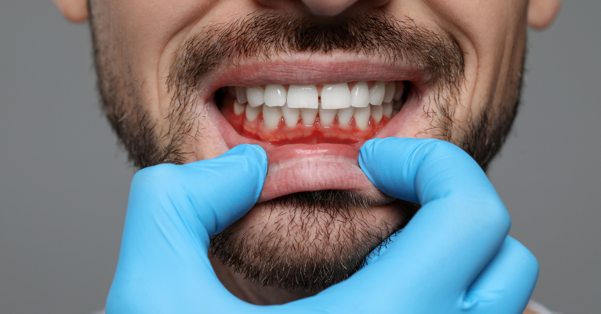 Gingivitis (Diş Eti İltihabı) - Dt Ayşe Erken