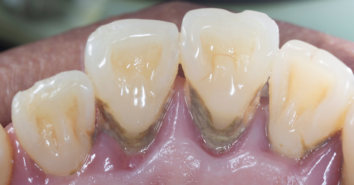 Lazer Destekli Periodontal Tedaviler - Dt Ayşe Erken