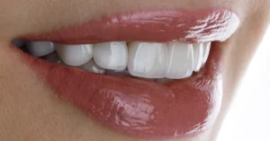 Porselen Diş - Dt Ayşe Erken