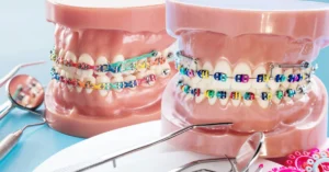 Diş Teli Tedavisi - Dt Ayşe Erken