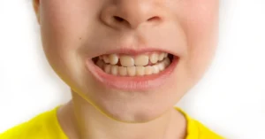 Çocuklarda Diş Gıcırdatma - Dt Ayşe Erken
