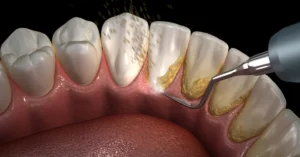 Diş Taşı Temizliği - Dt Ayşe Erken