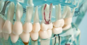 Başarısız Kanal Tedavisi Belirtileri Nelerdir - Dt Ayşe Erken