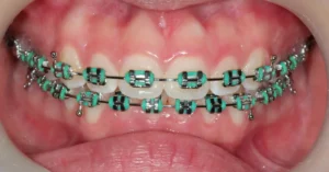 Ortodonti Tedavisi Fiyatları - Dt Ayşe Erken