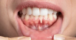 Diş Eti Çekilmesinin Nedenleri Nelerdir - Dt Ayşe Erken