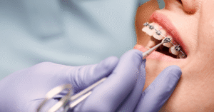 Dil Teli Kaç Yaşına Kadar Takılabilir - Dt Ayşe Erken