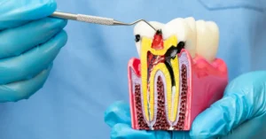 Kanal Tedavisi Sonrası Nelere Dikkat Edilmeli - Dt Ayşe Erken