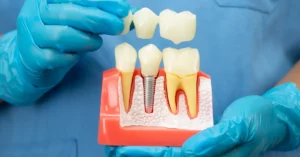 Implant Tedavisinde Hangi Durumlarda Basari Artar DT Ayse Erken