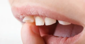 Çocuklarda Diş Kırılması Durumunda İlk Müdahale Nasıl Yapılır - DT Ayşe Erken