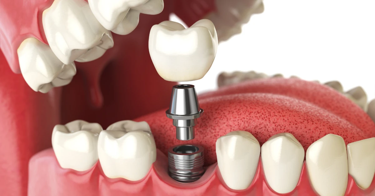 Implant Sonrasi Agiz Bakimi Nasil Olmali DT Ayse Erken