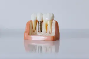 Farklı diş implantı bileşenlerinin görüldüğü eğitim amaçlı çene modeli, implant türlerini anlatan temsili görsel