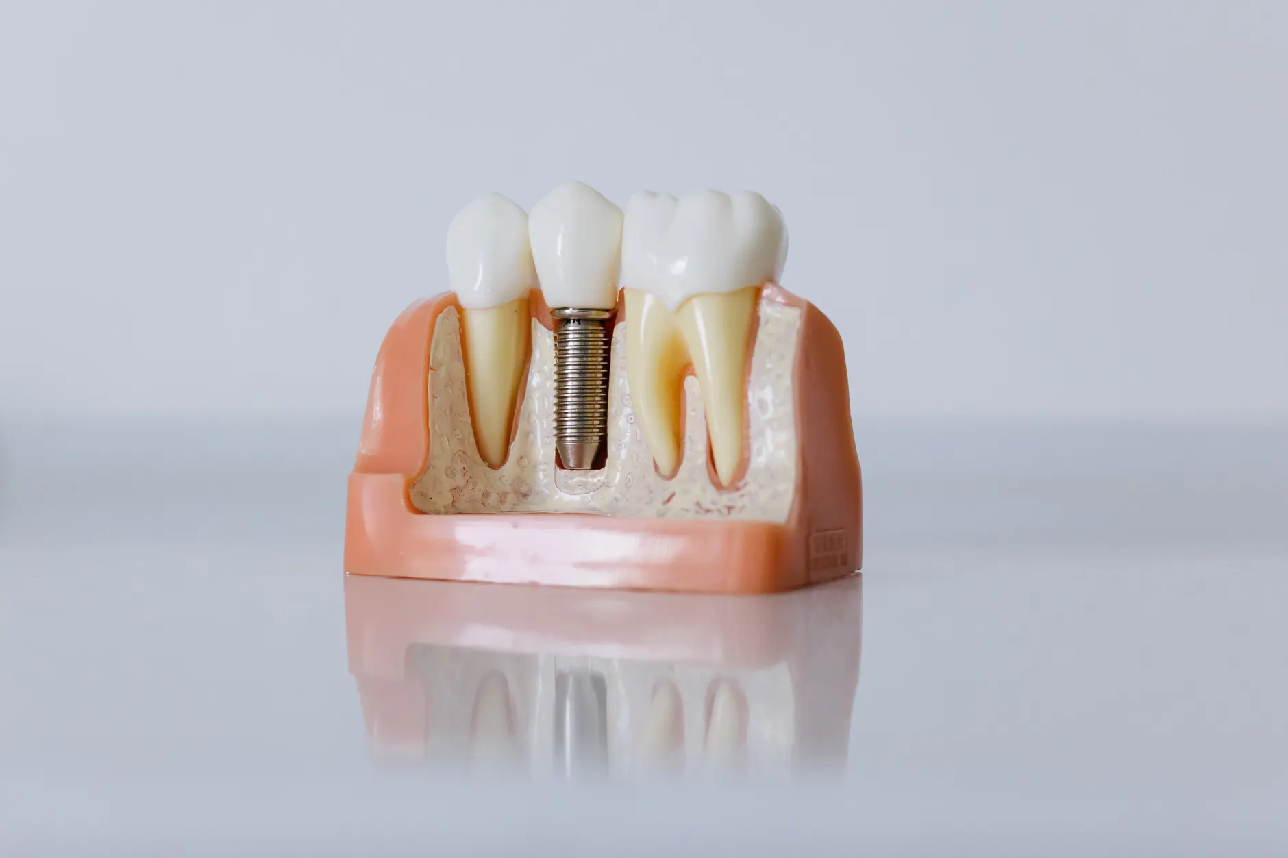 Farklı diş implantı bileşenlerinin görüldüğü eğitim amaçlı çene modeli, implant türlerini anlatan temsili görsel