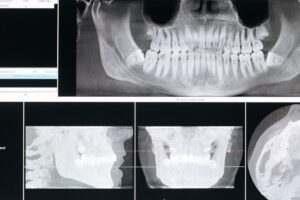 Ekranda görüntülenen panoramik ve üç boyutlu çene röntgenini gösteren temsili görsel, kemik erimesi ve implant konulu yazı için