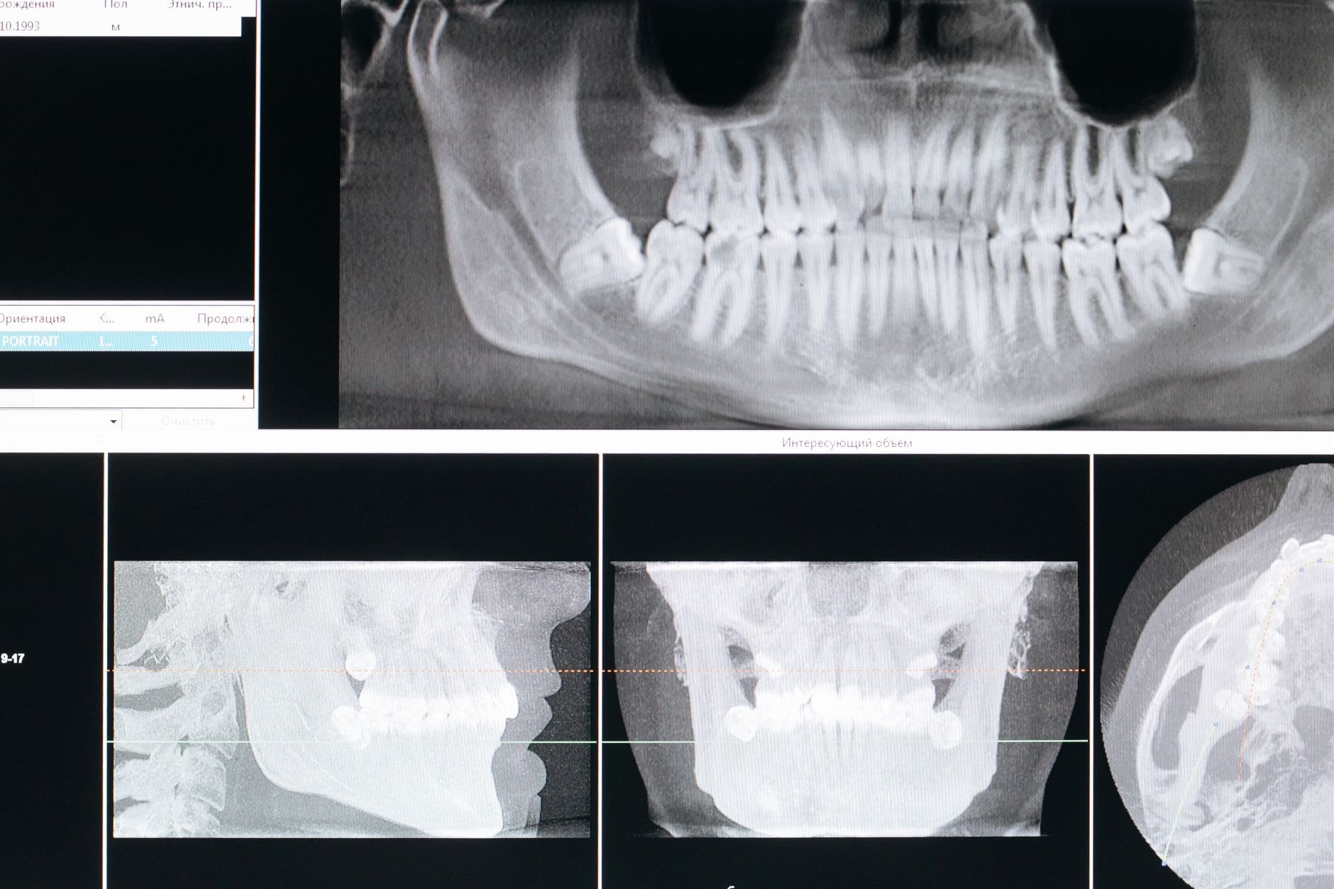 Ekranda görüntülenen panoramik ve üç boyutlu çene röntgenini gösteren temsili görsel, kemik erimesi ve implant konulu yazı için