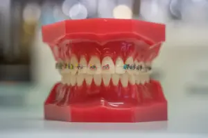 Braketli diş modelini gösteren temsili görsel, braket çeşitleri konulu yazı için